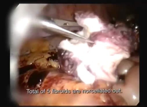 large fibroid
