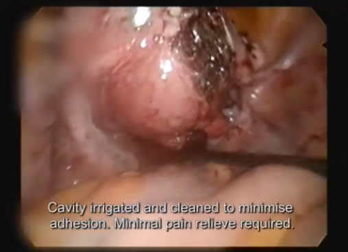large fibroid