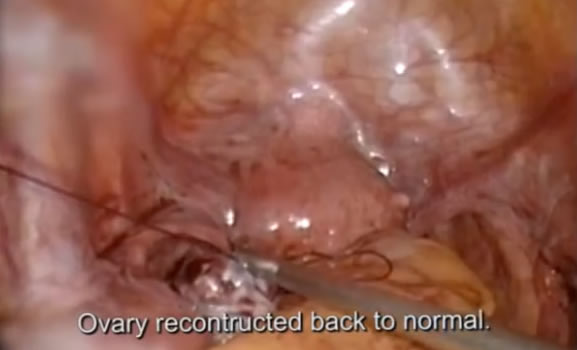 Gently separate the cyst wall