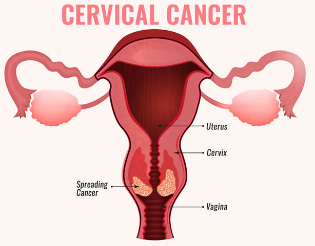Cervical cancer
