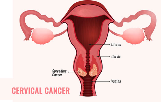 Cervical Cancer