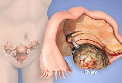 Ovarian cancer