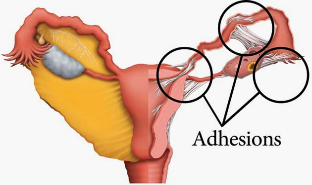 Adhesion discount