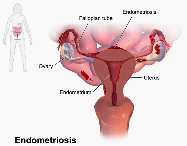 Kista Endometriosis Cyst<