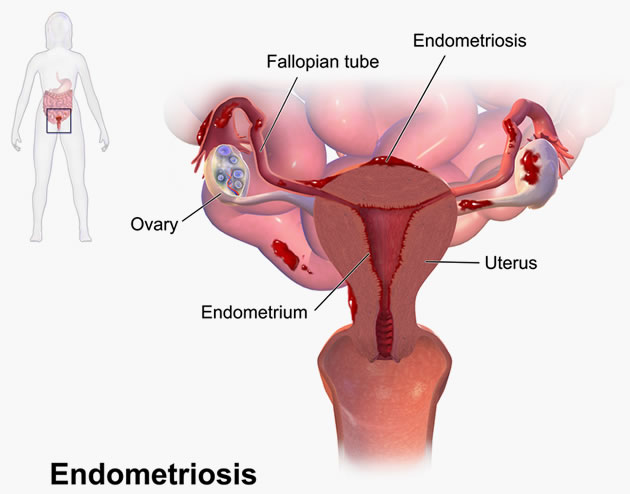 Gynae Laparoscopy Malaysia : Rupture in Large Kista Endometriosis Cyst