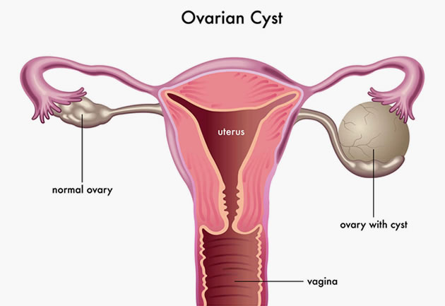 Ovarian Cysts