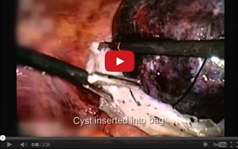 Complication Ovarian Cyst (Gangrenous)