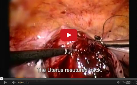 Laparascoppic Fibroid Removal