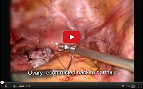 Large Dermoid
