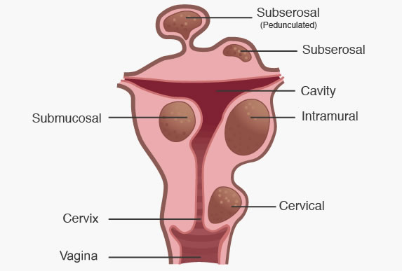 Subserosal Fibroids