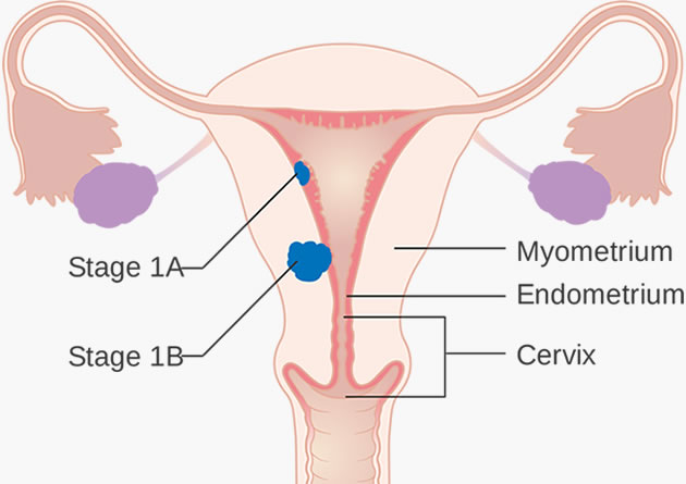 Uterine Cancer